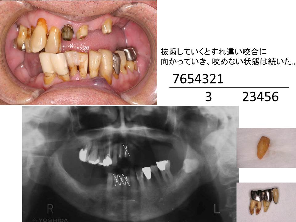 歯科医師 歯科衛生士向け 自家歯牙移植で咬合支持を獲得した症例 王禅寺歯科クリニック 川崎市の歯科は新百合ヶ丘 たまプラーザ駅近く